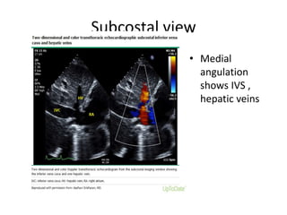 Subcostal view
• Medial
angulation
shows IVS ,
hepatic veins
 