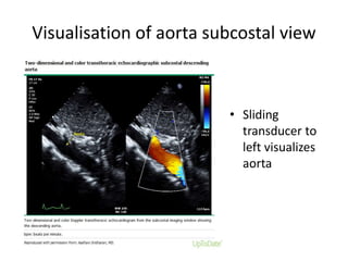 Visualisation of aorta subcostal view
• Sliding
transducer to
left visualizes
aorta
 