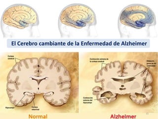 El Cerebro cambiante de la Enfermedad de Alzheimer
15
 
