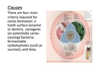 Causes
There are four main
criteria required for
caries formation: a
tooth surface (enamel
or dentin); cariogenic
(or potentially caries-
causing) bacteria;
fermentable
carbohydrates (such as
sucrose); and time.
 