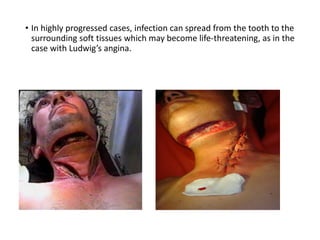 • In highly progressed cases, infection can spread from the tooth to the
surrounding soft tissues which may become life-threatening, as in the
case with Ludwig’s angina.
 