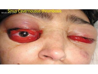Sinus Cavernousus thrombosis
 