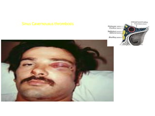 Sinus Cavernousus thrombosis
 