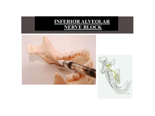 INFERIOR ALVEOLAR
NERVE BLOCK
 