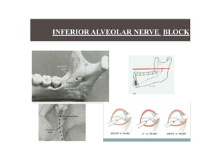 INFERIOR ALVEOLAR NERVE BLOCK
 