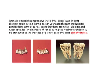 Archaeological evidence shows that dental caries is an ancient
disease. Sculls dating from a million years ago through the Neolitic
period show signs of caries, excepting those from the Paleolitic and
Mesolitic ages. The increase of caries during the neolithic period may
be attributed to the increase of plant foods containing carbohydtares.
 