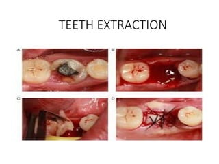 TEETH EXTRACTION
 