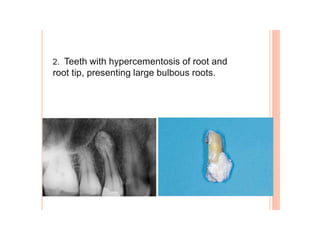 2. Teeth with hypercementosis of root and
root tip, presenting large bulbous roots.
 