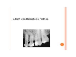 3.Teeth with dilaceration of root tips.
 