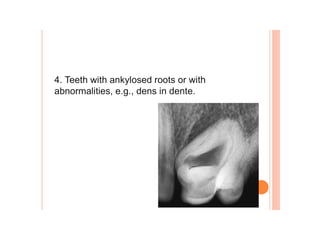 4. Teeth with ankylosed roots or with
abnormalities, e.g., dens in dente.
 