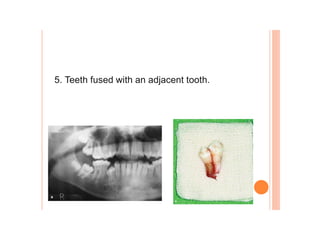 5. Teeth fused with an adjacent tooth.
 
