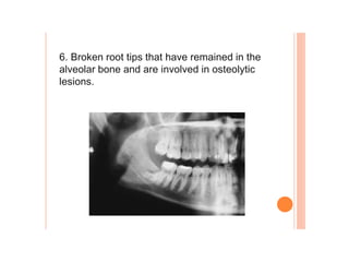 6. Broken root tips that have remained in the
alveolar bone and are involved in osteolytic
lesions.
 