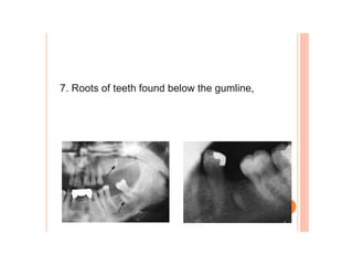 7. Roots of teeth found below the gumline,
 