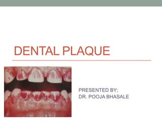 DENTAL PLAQUE
PRESENTED BY;
DR. POOJA BHASALE
 