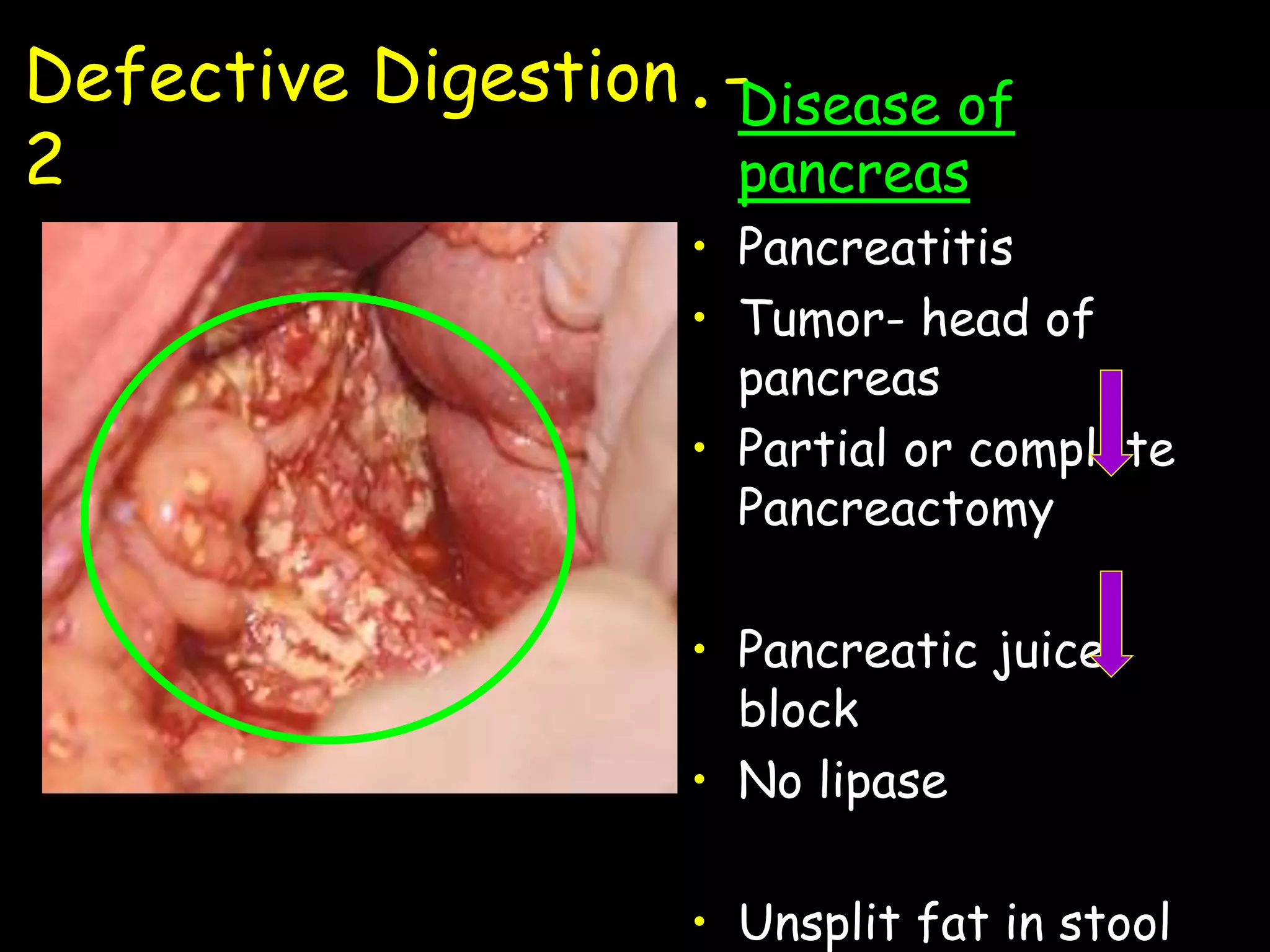 Defective Digestion -
2
• Disease of
pancreas
• Pancreatitis
• Tumor- head of
pancreas
• Partial or complete
Pancreactomy
• Pancreatic juice
block
• No lipase
• Unsplit fat in stool
 