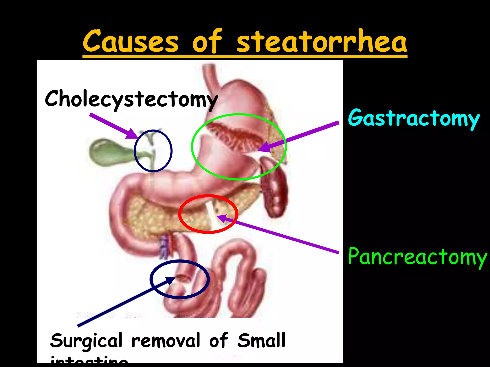 Causes of steatorrhea
Gastractomy
Pancreactomy
Surgical removal of Small
Cholecystectomy
 