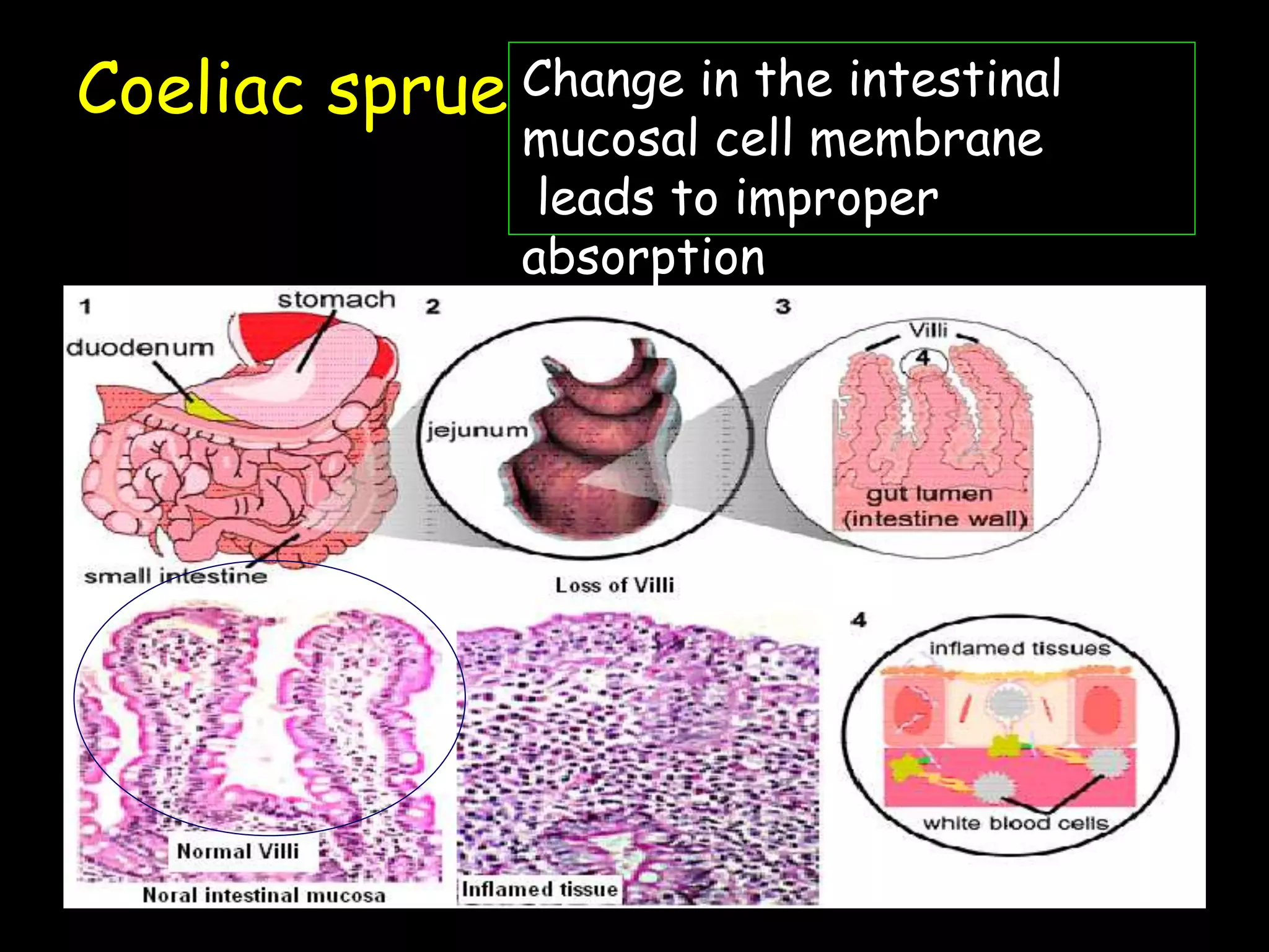Coeliac sprue Change in the intestinal
mucosal cell membrane
leads to improper
absorption
 