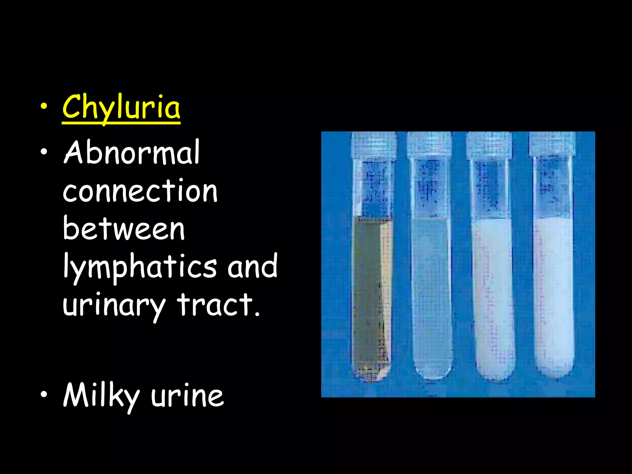 • Chyluria
• Abnormal
connection
between
lymphatics and
urinary tract.
• Milky urine
 
