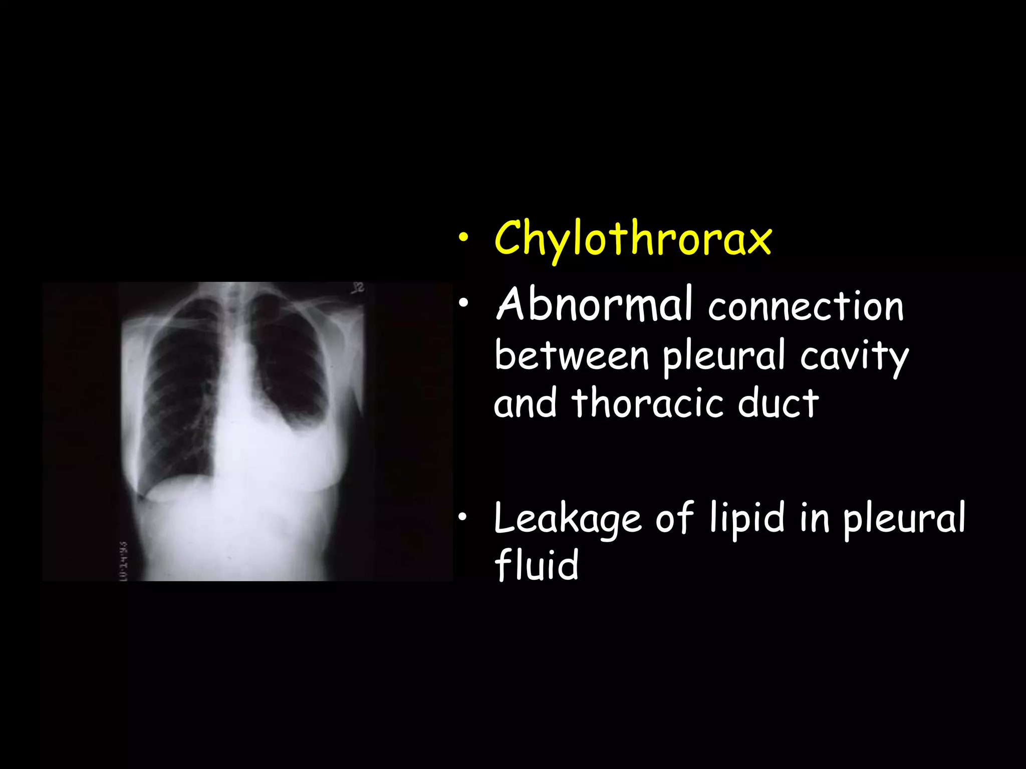 • Chylothrorax
• Abnormal connection
between pleural cavity
and thoracic duct
• Leakage of lipid in pleural
fluid
 