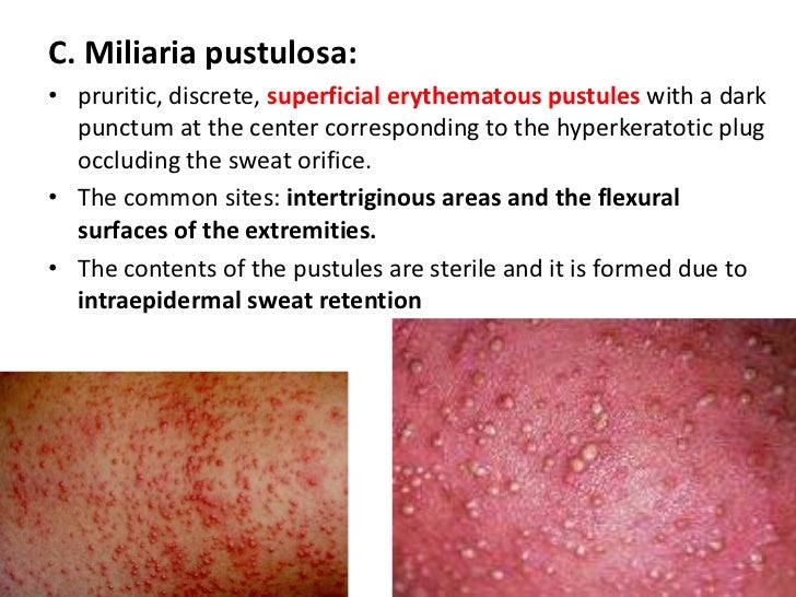 Miliaria Rubra Pictures Photos Miliaria Rubra Pictures Photos