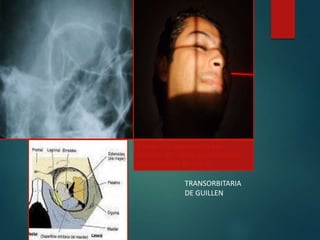 V
Proyección parietoorbitaria-
rotación 53°, línea acantiomeatal
perpendicular al rayo C.
TRANSORBITARIA
DE GUILLEN
 