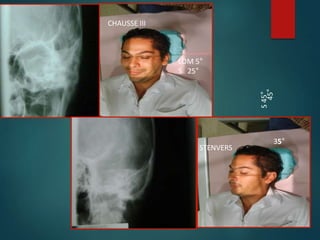 LOM 5°
S 25°
S
45°
35°
STENVERS
45°
CHAUSSE III
 