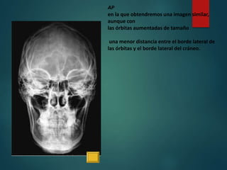 AP
en la que obtendremos una imagen similar,
aunque con
las órbitas aumentadas de tamaño
una menor distancia entre el borde lateral de
las órbitas y el borde lateral del cráneo.
 
