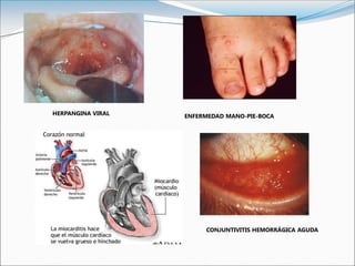 HERPANGINA VIRAL ENFERMEDAD MANO-PIE-BOCA
CONJUNTIVITIS HEMORRÁGICA AGUDA
 