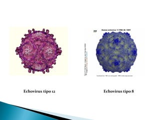 Echovirus tipo 12 Echovirus tipo 8
 