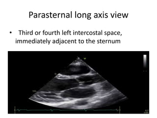2d Transthoracic Echocardiographic views | PPT