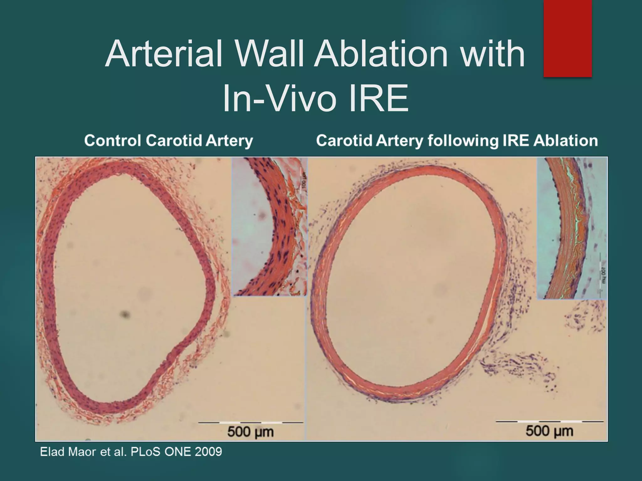Arterial Wall Ablation with
In-Vivo IRE
 