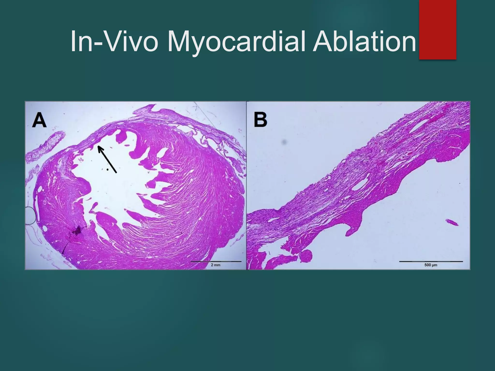 In-Vivo Myocardial Ablation
 