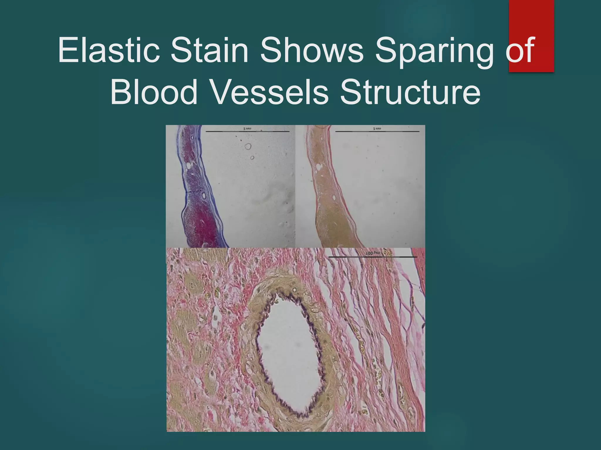 Elastic Stain Shows Sparing of
Blood Vessels Structure
 