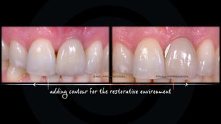 adding contour for the restorative environment
2nd. provisional final impression
 