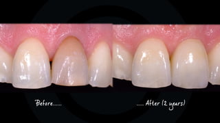 Before...... ..... After (2 years)
 