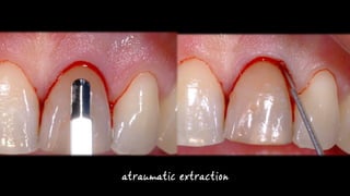 atraumatic extraction
 