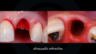 atraumatic extraction
 