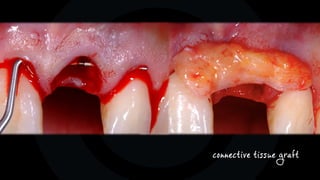 connective tissue graft
 