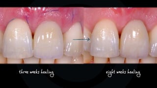 eight weeks healingthree weeks healing
 