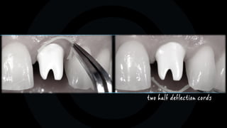 two half deflection cords
 