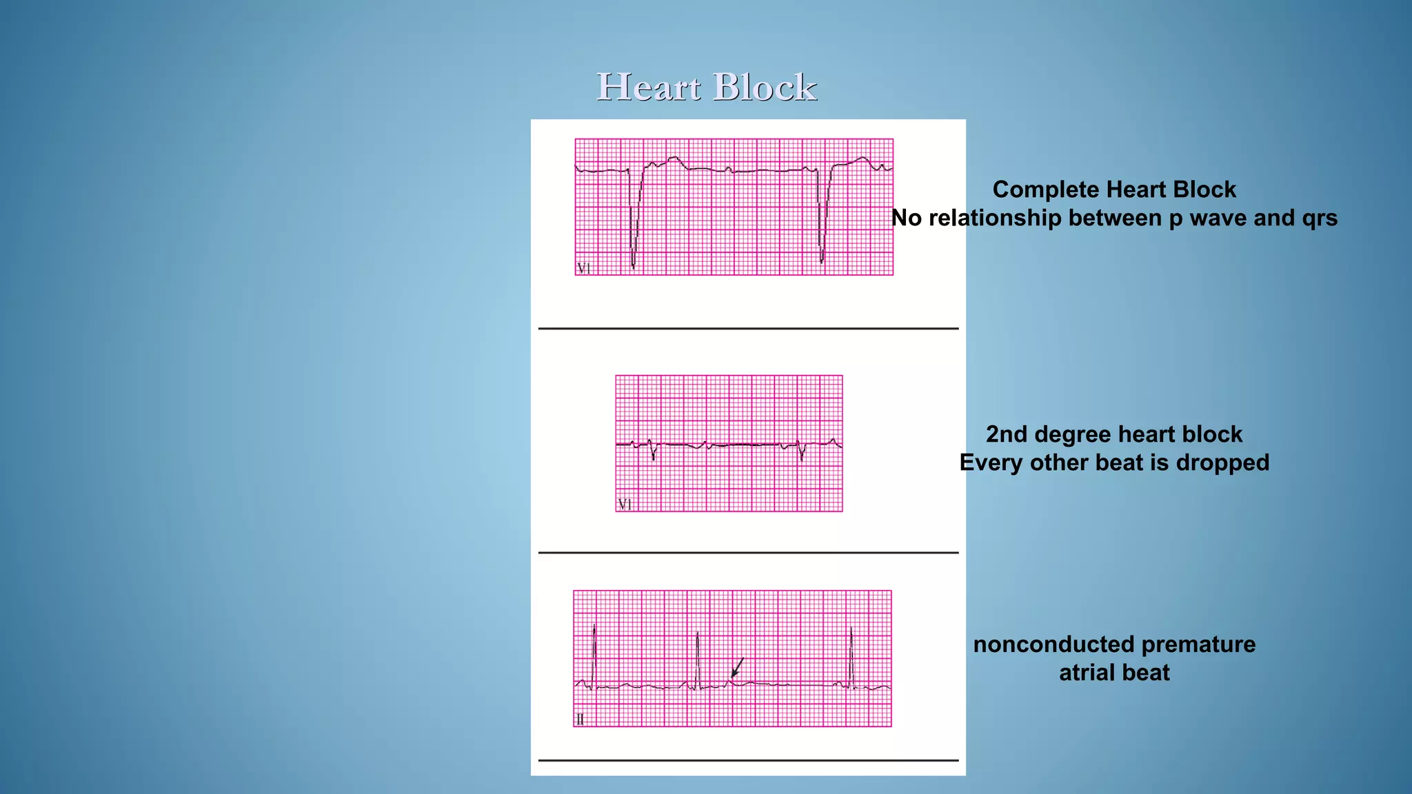 Heart Block
Complete Heart Block
No relationship between p wave and qrs
2nd degree heart block
Every other beat is dropped
nonconducted premature
atrial beat
 