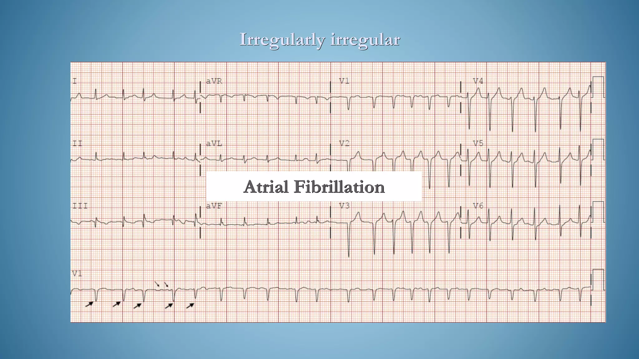 Irregularly irregular
Atrial Fibrillation
 