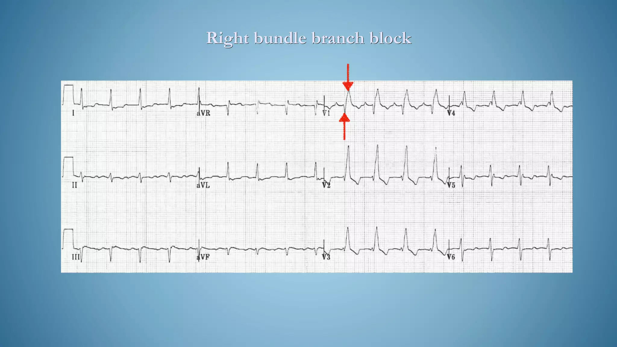 Right bundle branch block
 