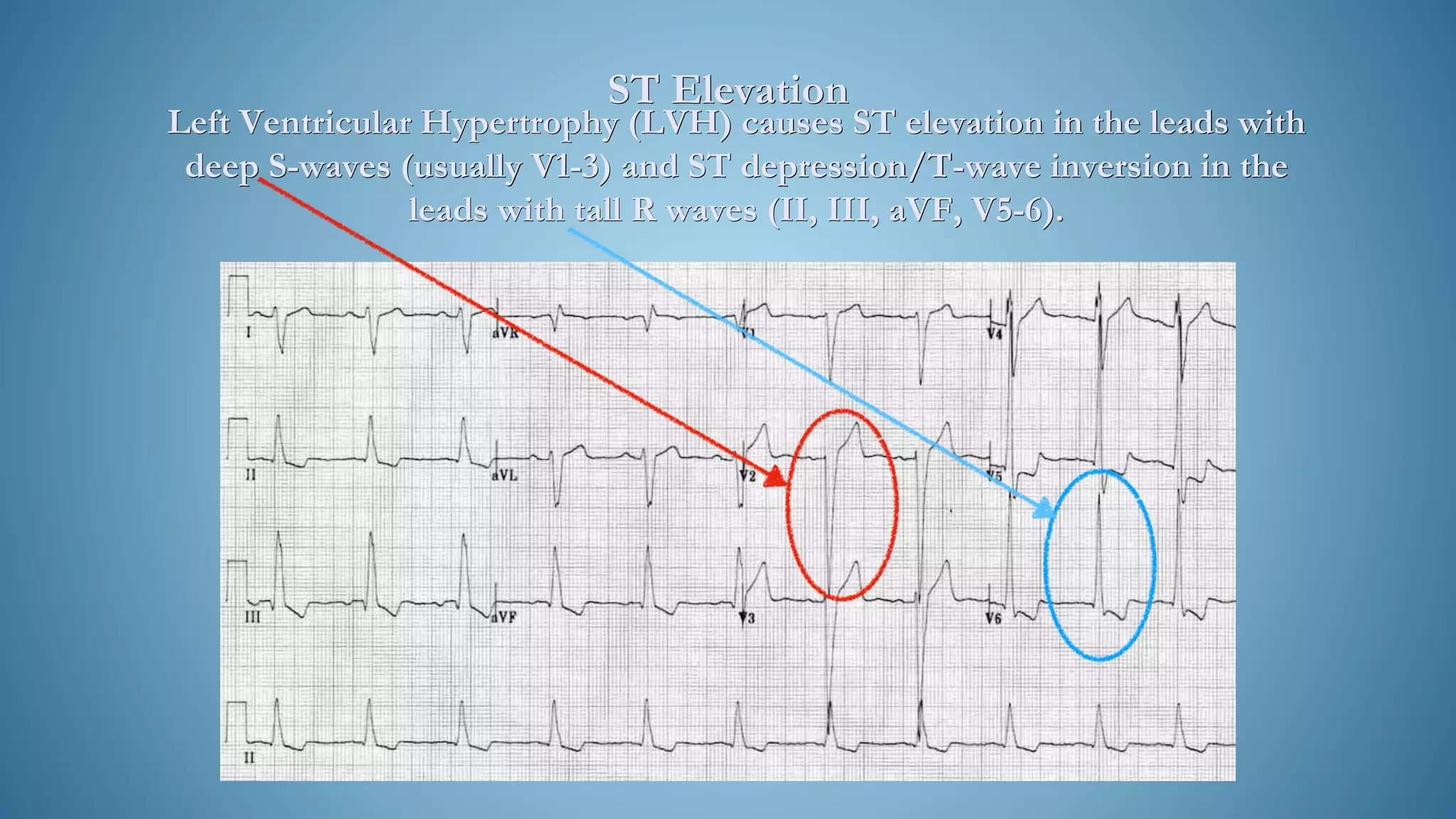 ST Elevation
Left Ventricular Hypertrophy (LVH) causes ST elevation in the leads with
deep S-waves (usually V1-3) and ST depression/T-wave inversion in the
leads with tall R waves (II, III, aVF, V5-6).
 