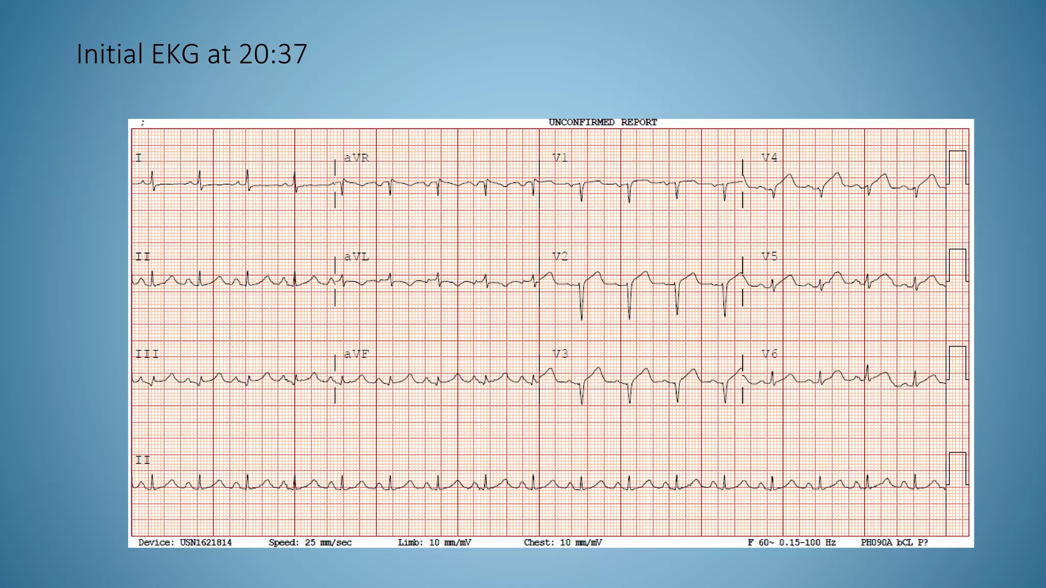 Initial EKG at 20:37
 