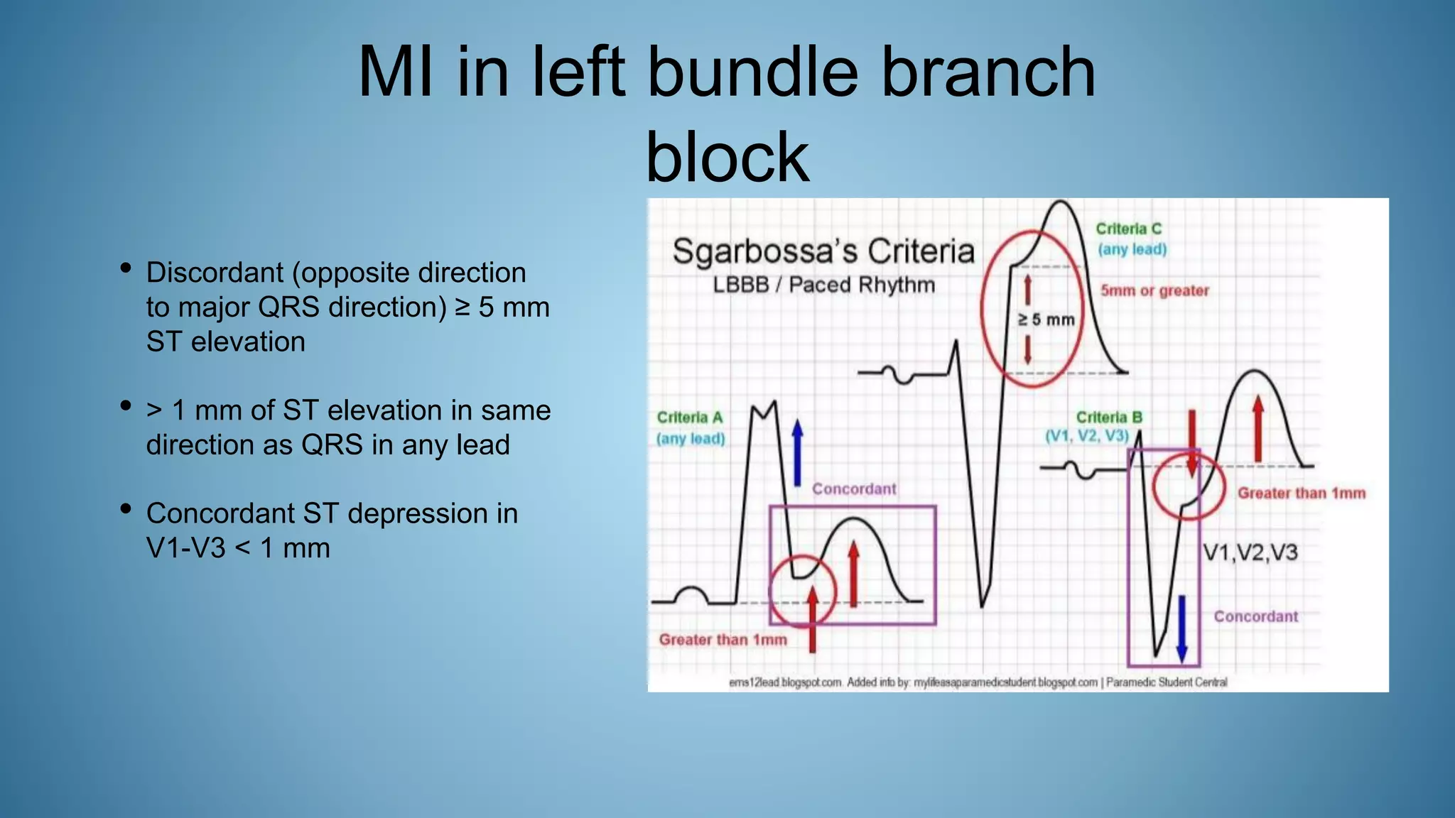 MI in left bundle branch
block
• Discordant (opposite direction
to major QRS direction) ≥ 5 mm
ST elevation
• > 1 mm of ST elevation in same
direction as QRS in any lead
• Concordant ST depression in
V1-V3 < 1 mm
 