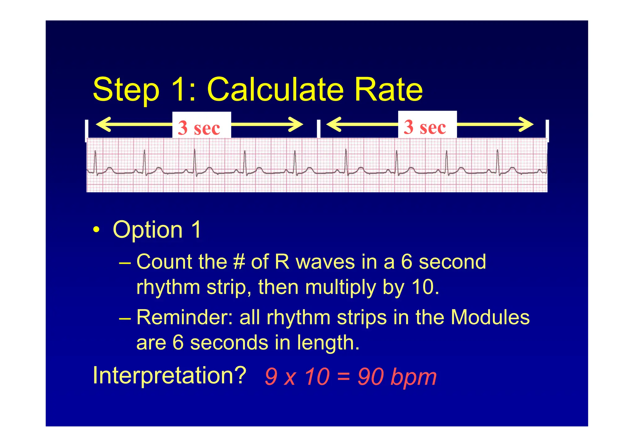 ECG Rhythm Interpretation (ECG Rhythm Analysis) | PDF
