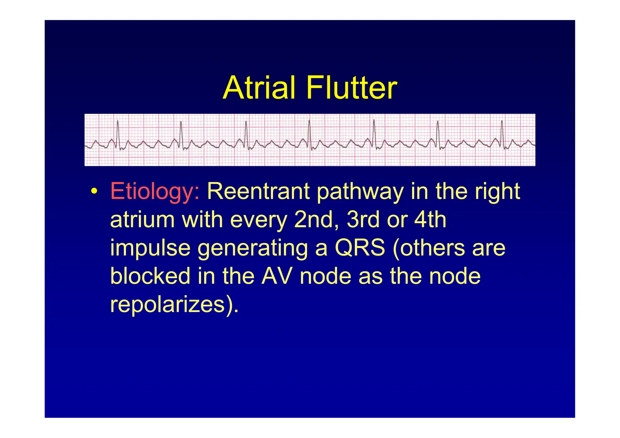 ECG Rhythm Interpretation (ECG Rhythm Analysis) | PDF