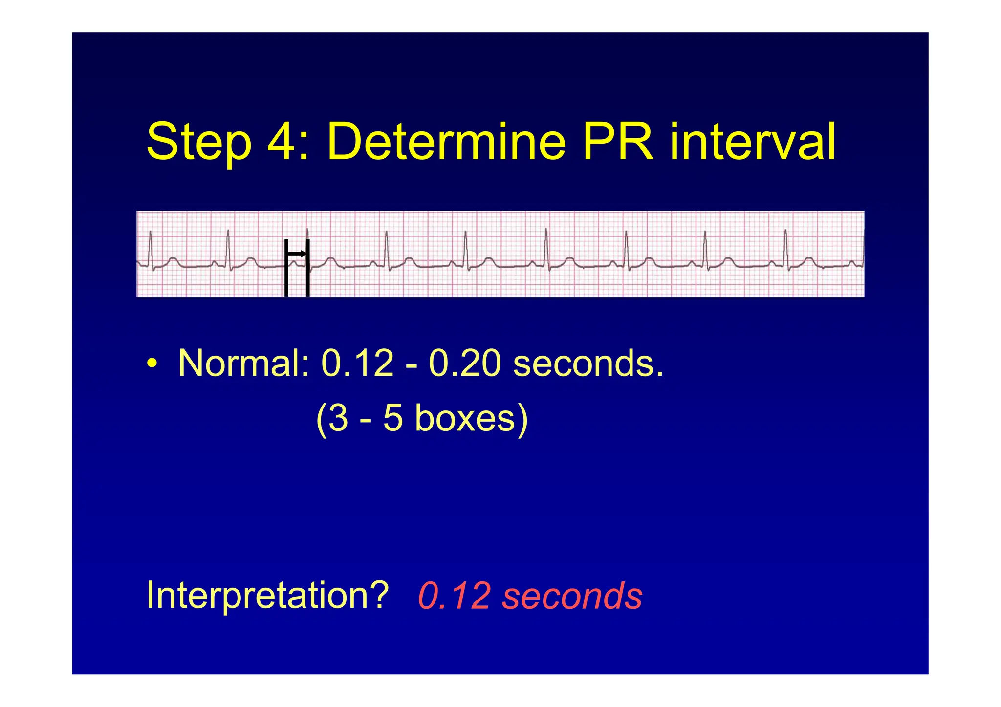 ECG Rhythm Interpretation (ECG Rhythm Analysis) | PDF
