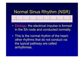 Sa Node Normal Rhythm ECG Rhythm Interpretation (ECG Rhythm Analysis) | PDF
